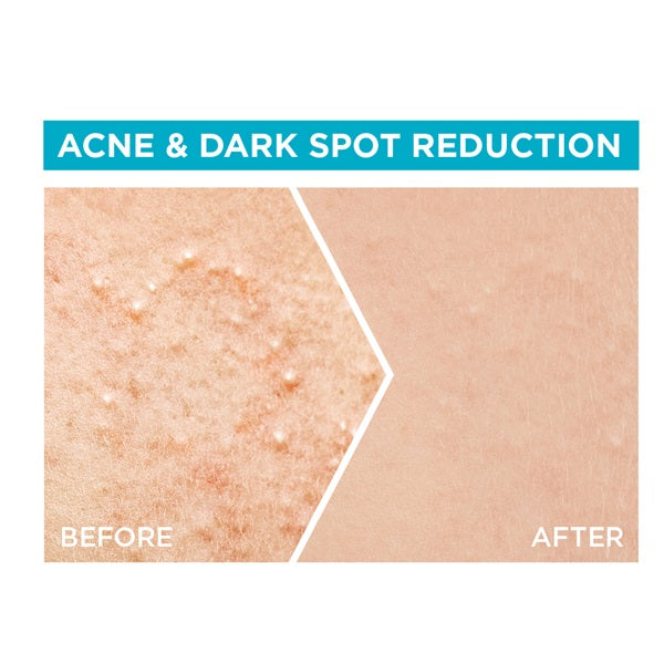 Garnier - Fast Clear 4% Salicylic Acid, Vitamin C, Niacinamide, AHA - Anti-Acne Treatment Booster Serum
