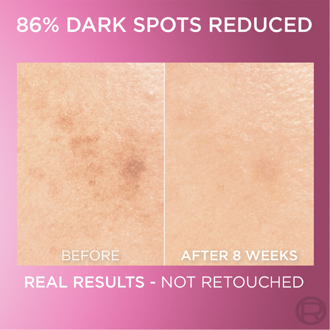 Before and after comparison of dark spots on skin with text indicating 86% reduction.